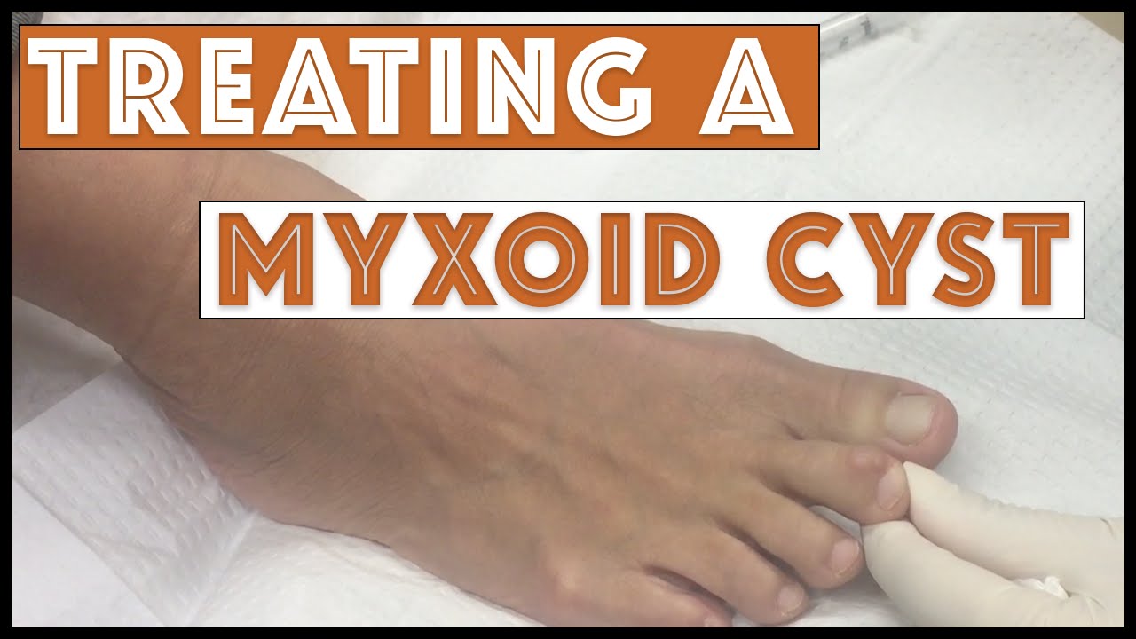 Myxoid Cyst Treatment Market Size, Status, Growth | Industry Analysis Report 2020-2027