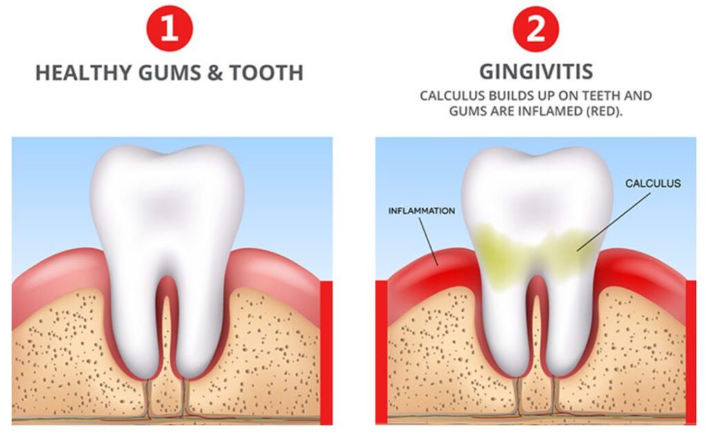 Bleeding Gums Causes