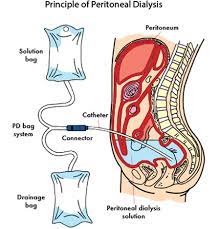 Hemodialysis and Peritoneal Dialysis Market Report 2022 | Global Industry Trends, Forecasts and Opportunity Assessment Till 2028