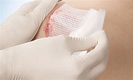 Global Wound Dressings Market 2021 Analysis Report by Recent Developments and Emerging Technologies Till 2027