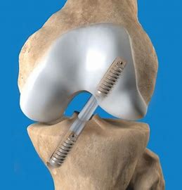 ACL Reconstruction Market 2022 Size & Forecast Research Report