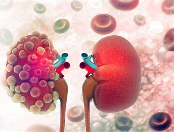 Kidney/Renal Cancer Drugs Market Drivers, Restraints and Challenges Analysis Report 2021-2027