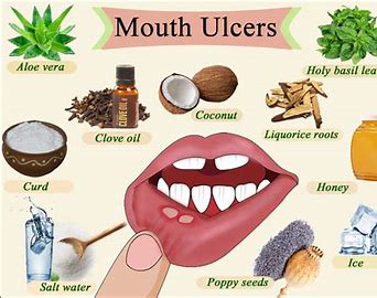 Global Mouth Ulcers Treatment Market 2021 Analysis Report by Recent Developments and Emerging Technologies Till 2027