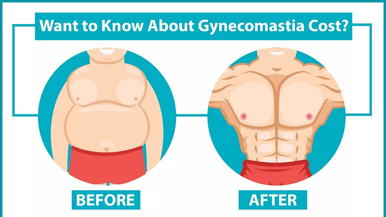 Is Gynecomastia Surgery Costly?