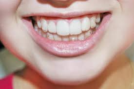 What Are Invisalign Attachments? 