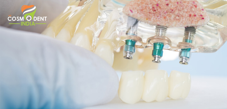 All You Need to Know about Dental Implants - Cosmodent India
