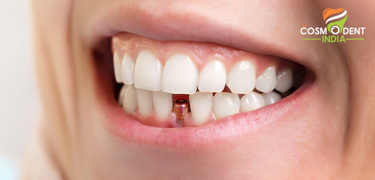 Benefits of Dental Implants and the Best Place for It - Cosmodent India