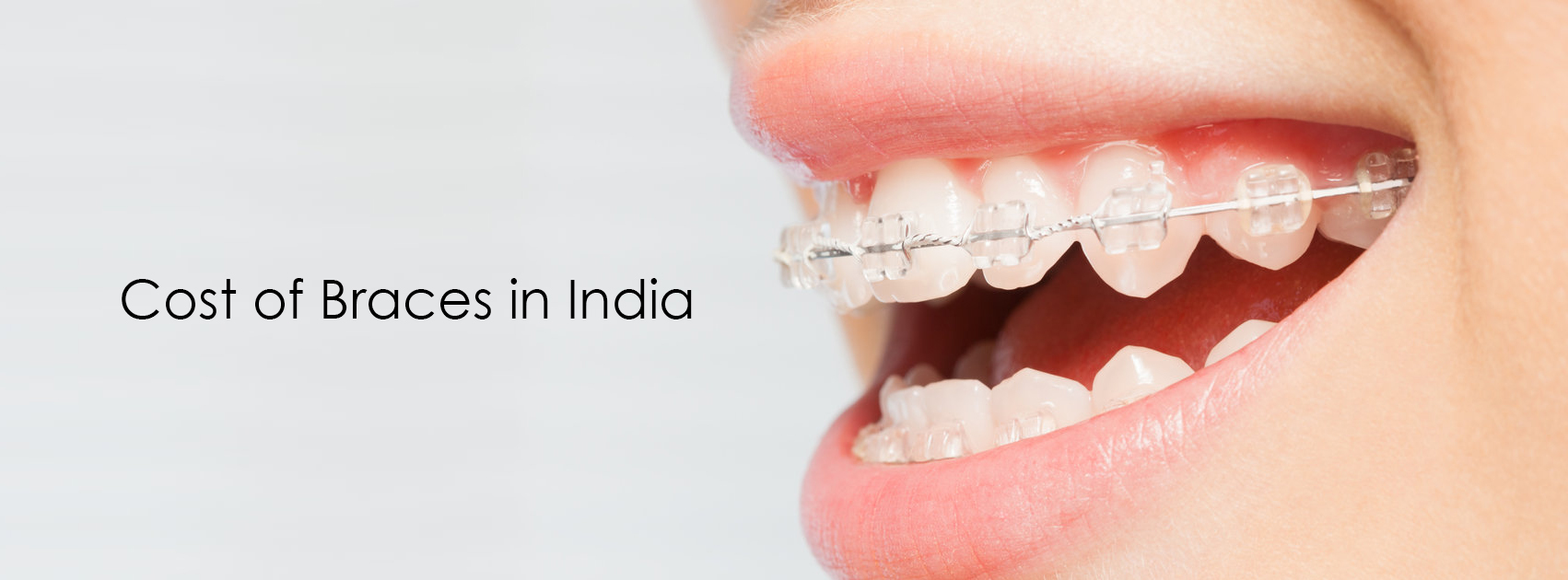 Cost of Braces in India - Cosmodent India