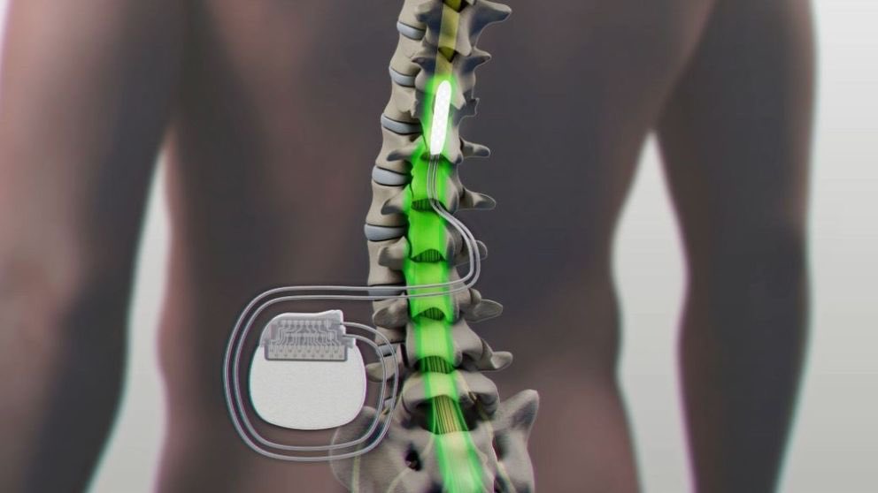 What are the Benefits of Spinal Non-Fusion Devices?