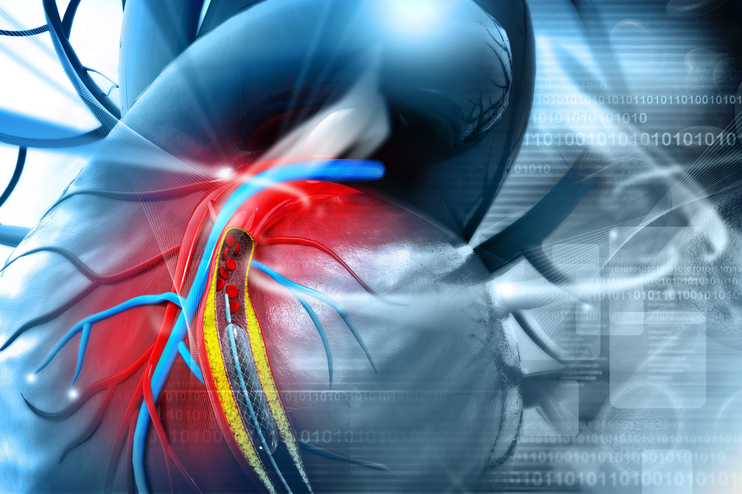 What are the benefits of Cardiovascular Stents?