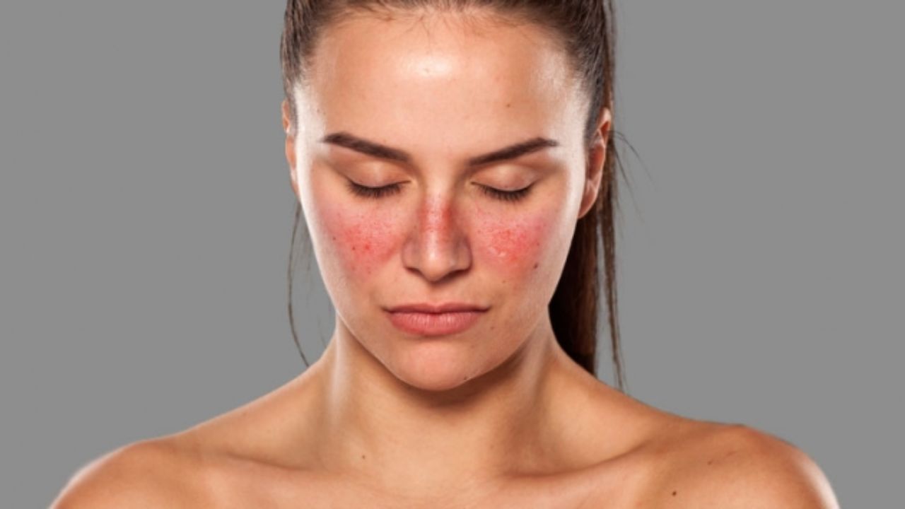 What is Systemic Lupus Erthematosus Treatment?
