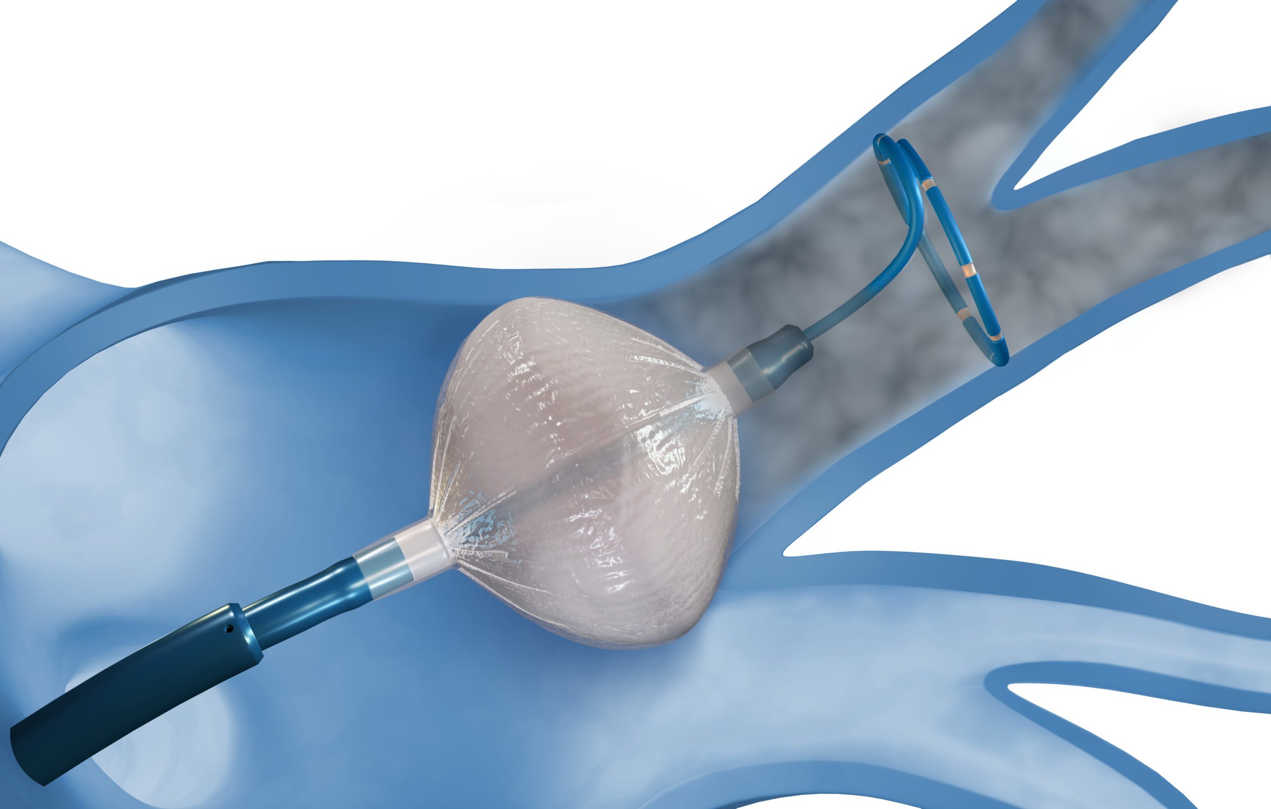 Cryoablation Devices for the Treatment of Bone Cancer: Promising Results