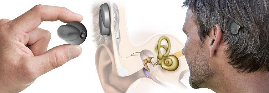 There are Two Main Types of Middle Ear Implants: Piezoelectric and Electromagnetic