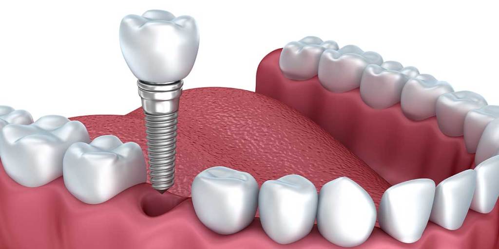 Most Effective Solutions Of Dental Implement Services in Longview