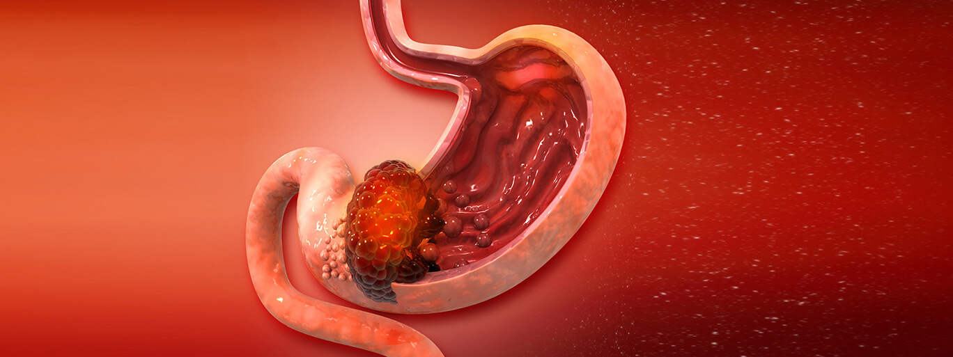 Survival Rate for Stomach (Gastric) Cancer - Cancer Surgery Clinic