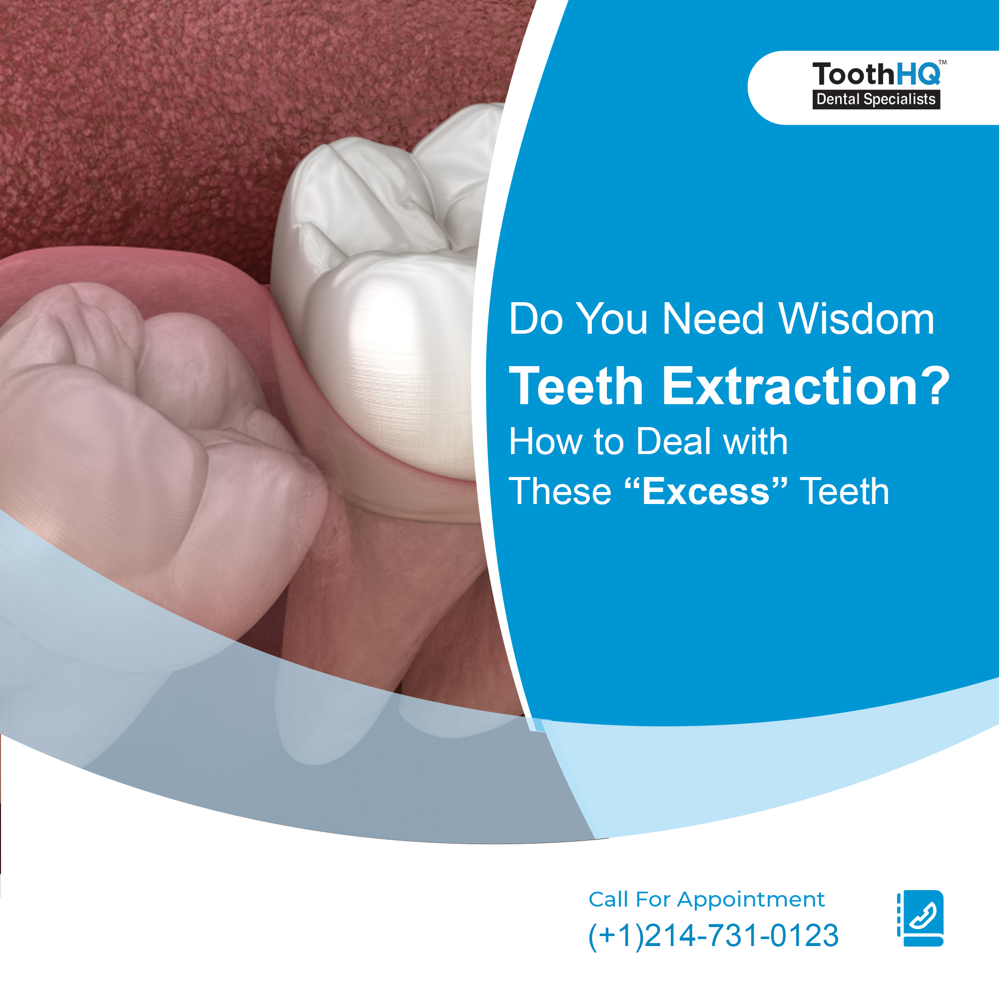 What Should I Pay Attention to After Wisdom Teeth Extraction?