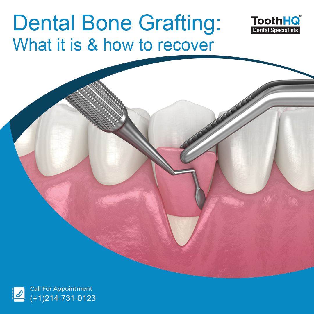 The Dental Bone Grafting Process
