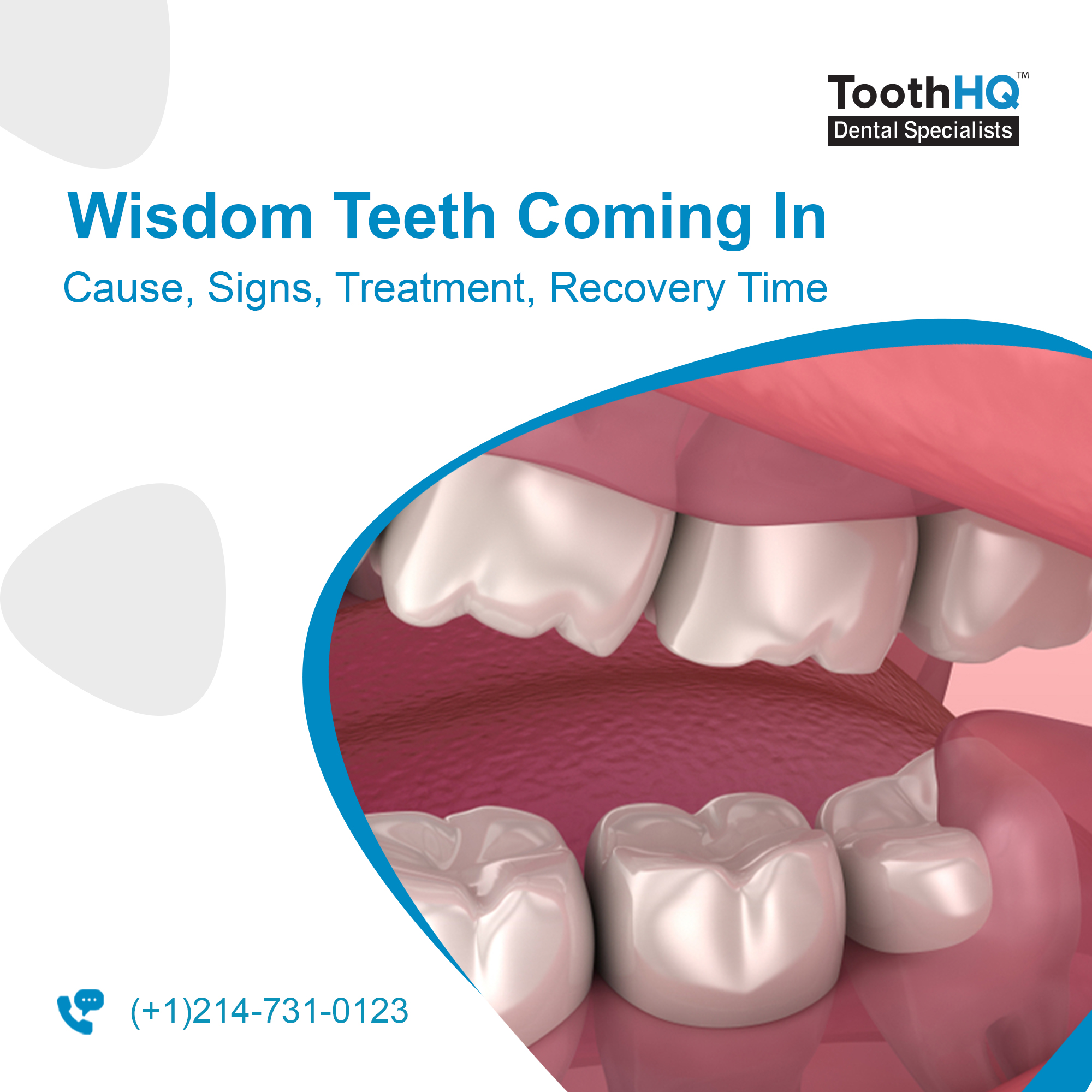 Causes of Wisdom Tooth Impaction