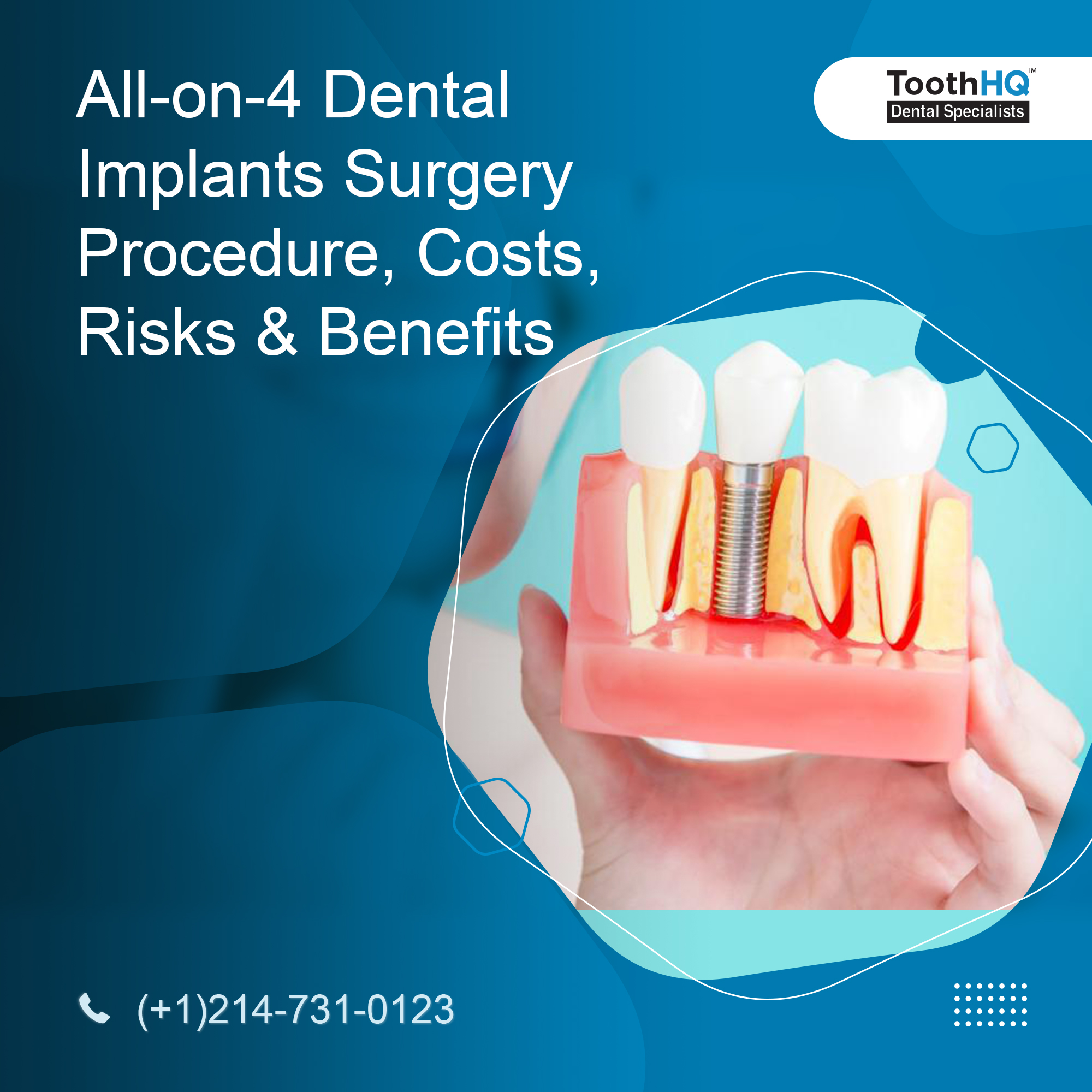 All-on-4 Dental Implants Surgery: Procedure, Costs, Risks & Benefits