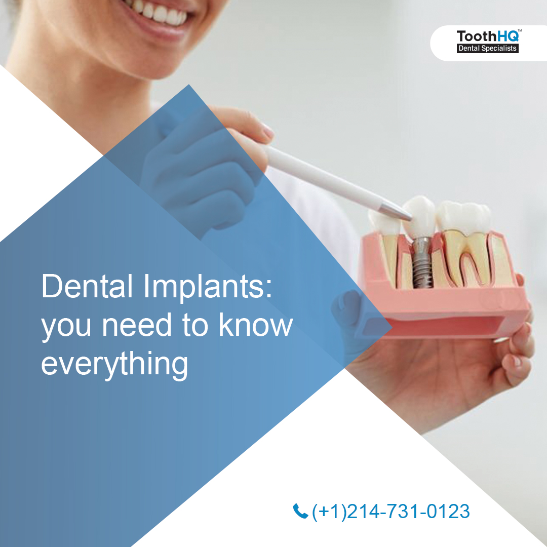 How do we define Dental Implants?
