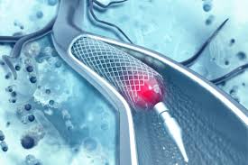 Cardiac Stent Market Report 2022 | Global Industry Trends, Forecasts and Opportunity Assessment Till 2028