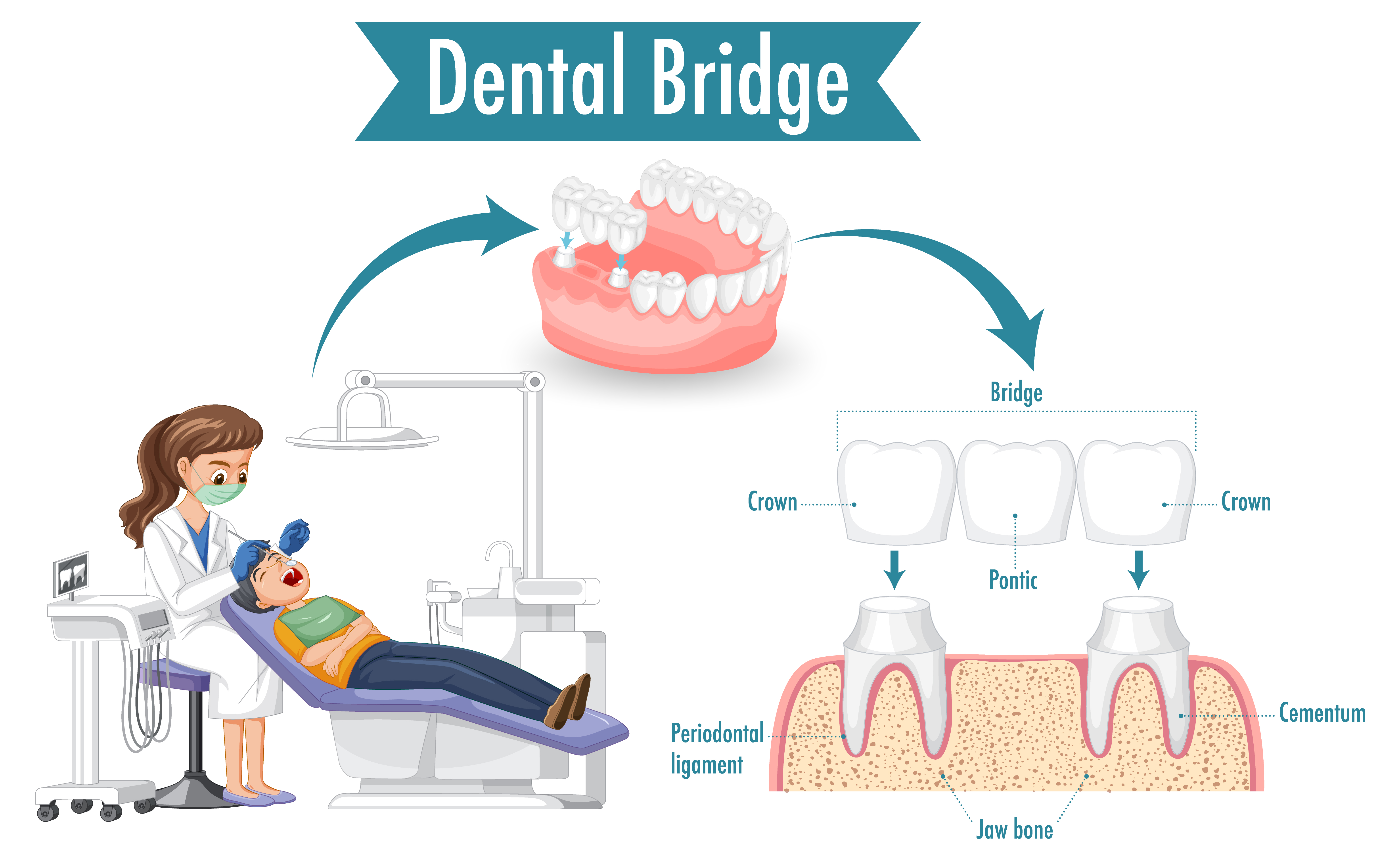 What to Expect in a Dental Bridge Procedure