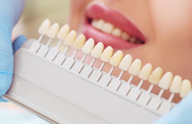 Amazing Things to Know Before Choosing Porcelain Veneers