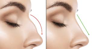 Nose Bone Surgery Cost in Pakistan