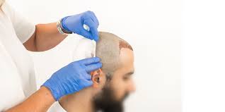 Hair Transplant in Islamabad, Pakistan
