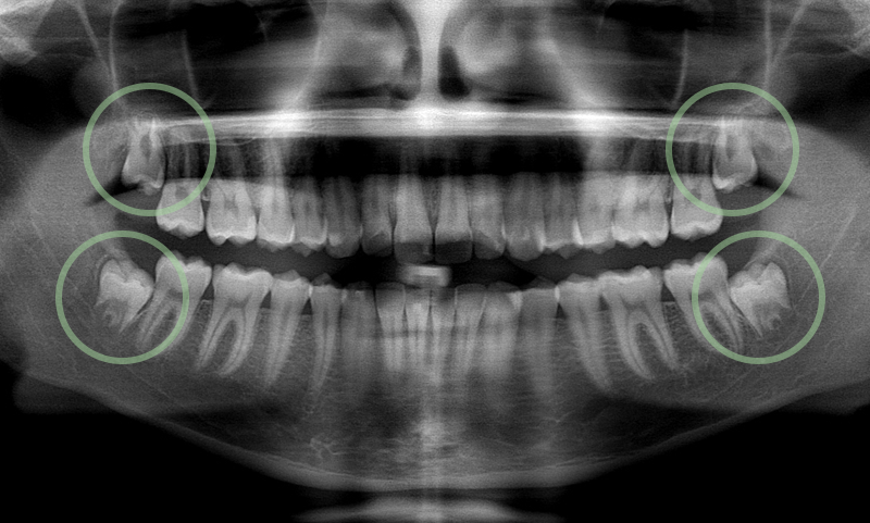 Wisdom tooth extraction: Advantages & Risk