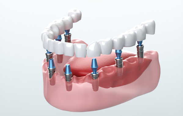 Where Can I Get Dental Implants in Toronto?  