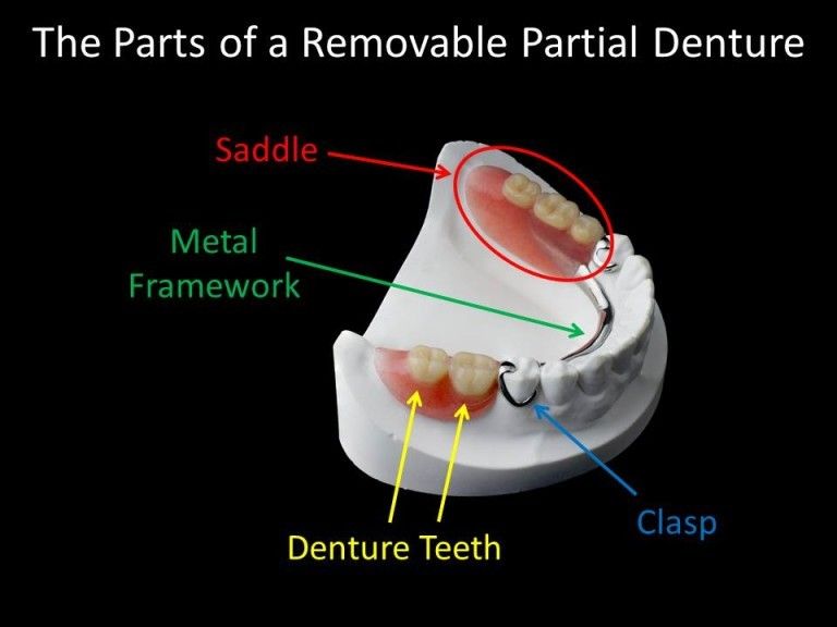 Exploring the Components of Partial Dentures: A Guide to Tooth Requirements