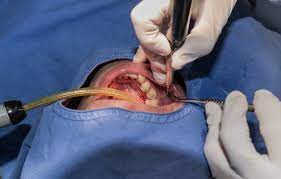 Oral Surgery in Noida