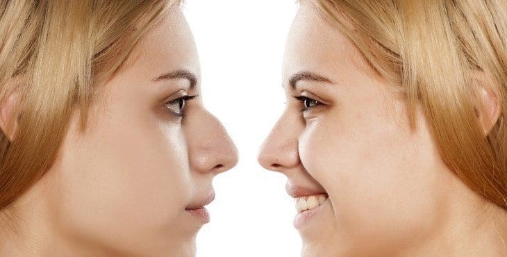 ما هي جراحة تجميل الأنف ومن يجب أن يخضع لها؟