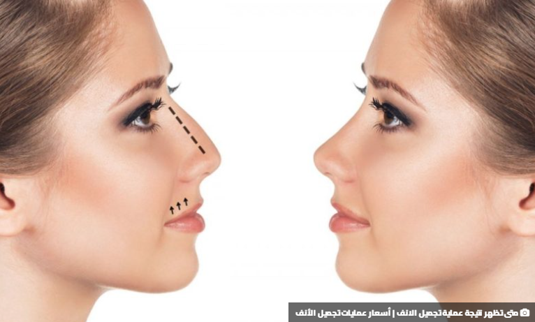 عملية تجميل الأنف مفيدة لجراحة الأنف بسعر مناسب