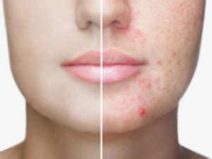 Acne Treatment Market 2022 Trends, Share, Growth, Opportunity and Forecast 
