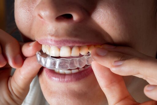 Invisalign Is the Most Chosen Aligner by Millions
