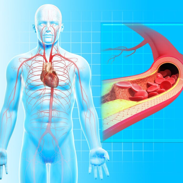 Peripheral Arterial Disease Treatment In India