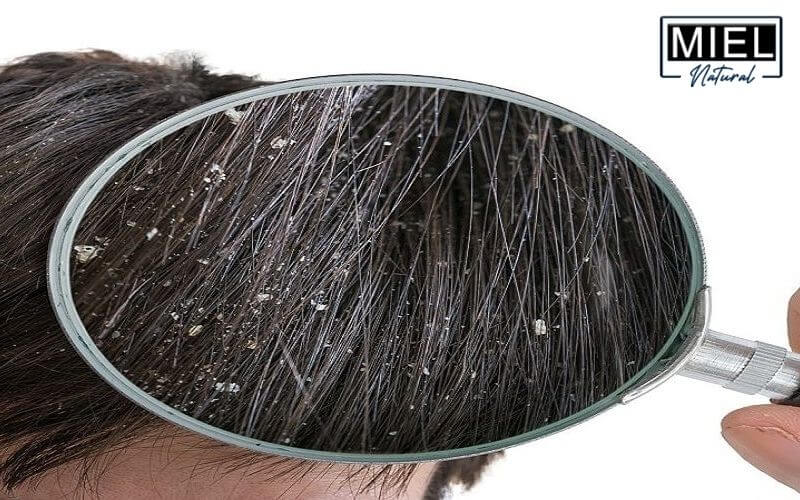 Miel Natural | Natural Remedies for Dandruff