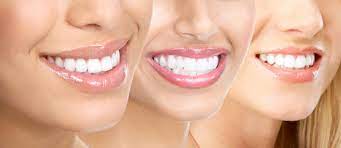 Veneers vs. Crowns: Which is Right for you?