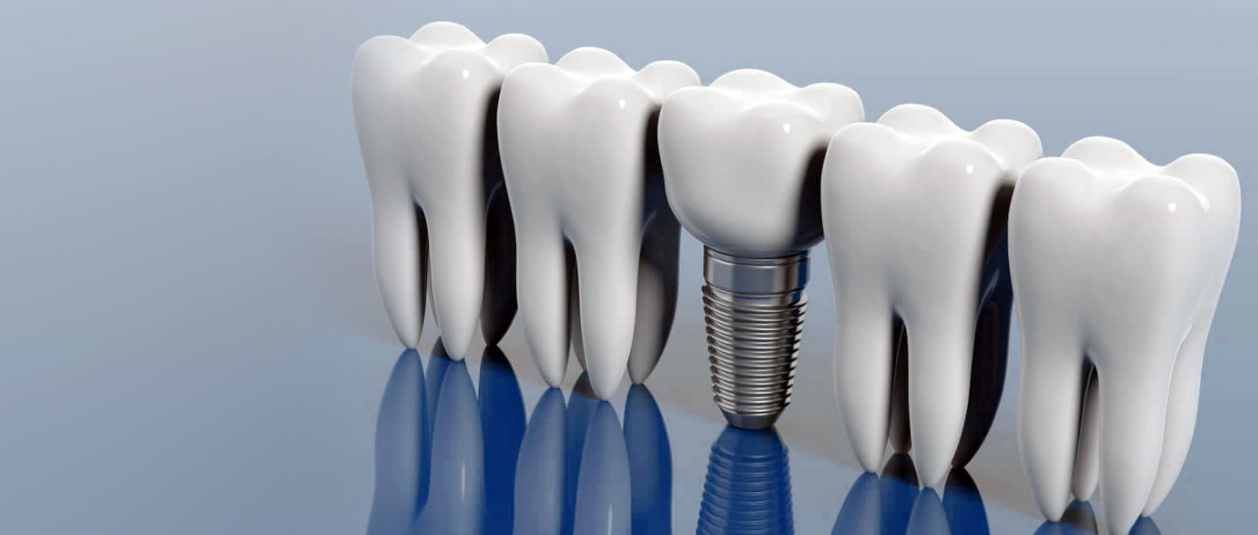 What Are Full Mouth Dental Implants Boca Raton, And What Should You Know About Them?