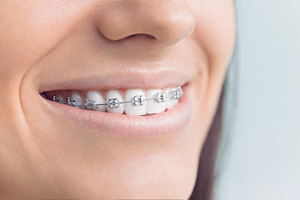 Achieve a Beautiful Smile with Braces in Lake Forest: Top Orthodontic Care at Braces Laguna Hills