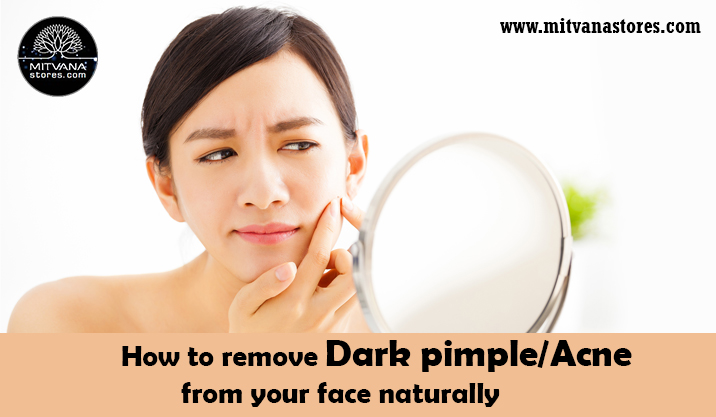 How to remove dark pimples or Acne from your face naturally