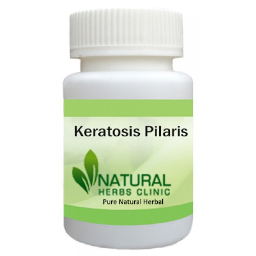 Herbal Treatment for Keratosis Pilaris - Natural Herbs Clinic