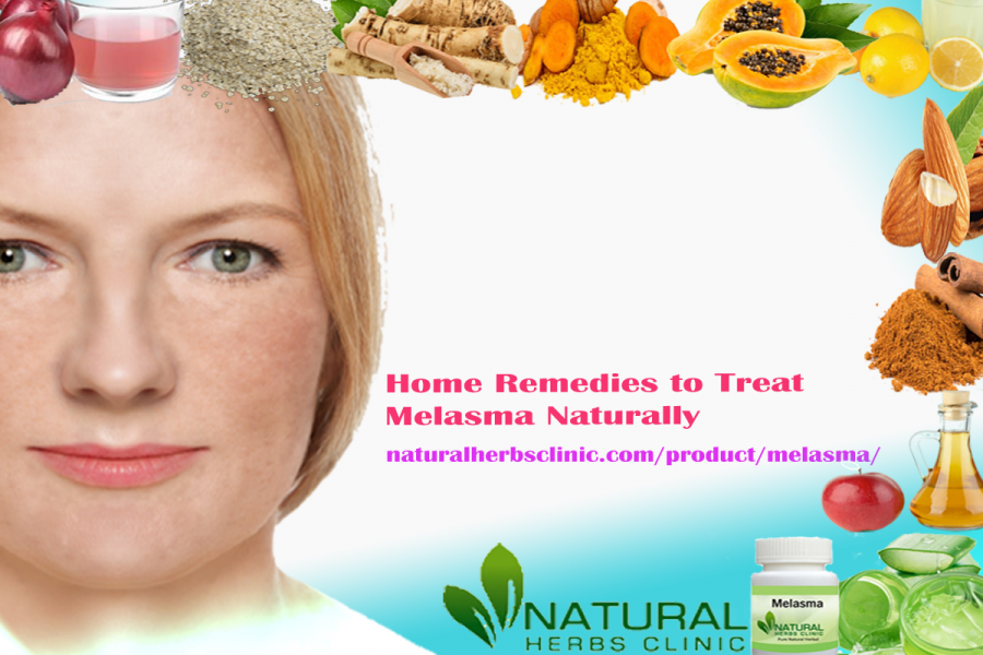 Home Remedies for Melasma