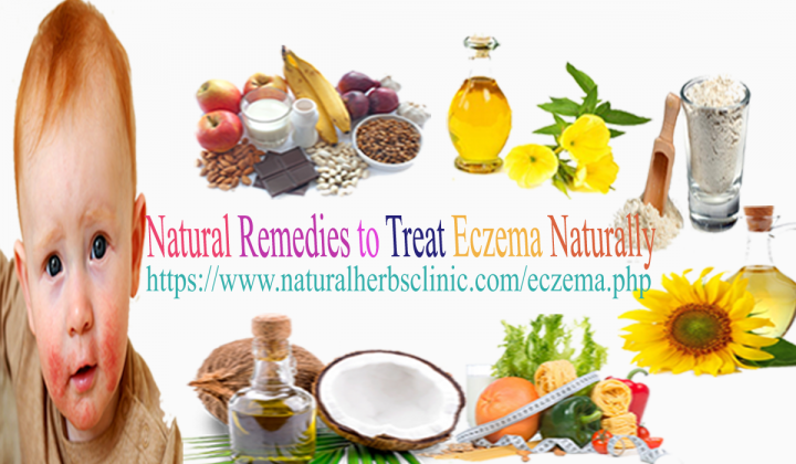 Natural Remedies for Eczema in Children