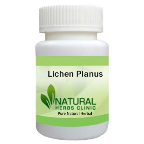 Herbal Treatment for Lichen Planus - Natural Herbs Clinic