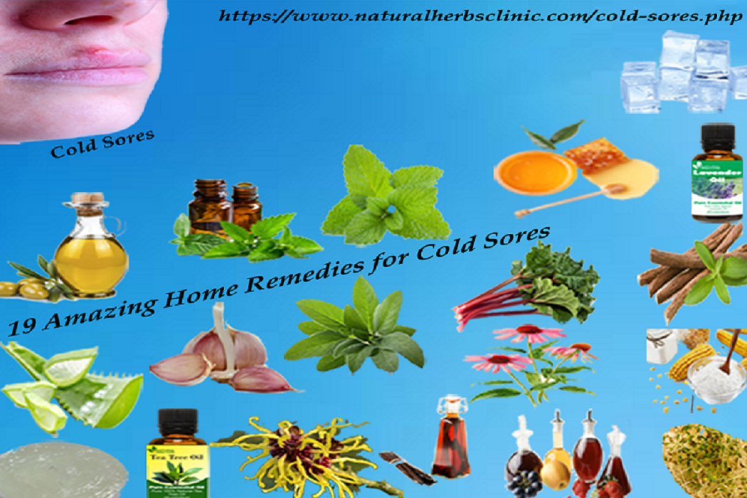 19 Amazing Home Remedies for Cold Sores