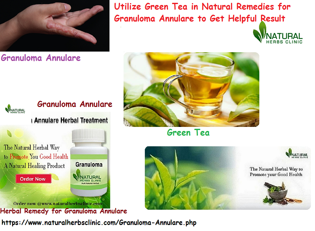 4 Natural Remedies for Granuloma Annulare to Stop the Skin Disease