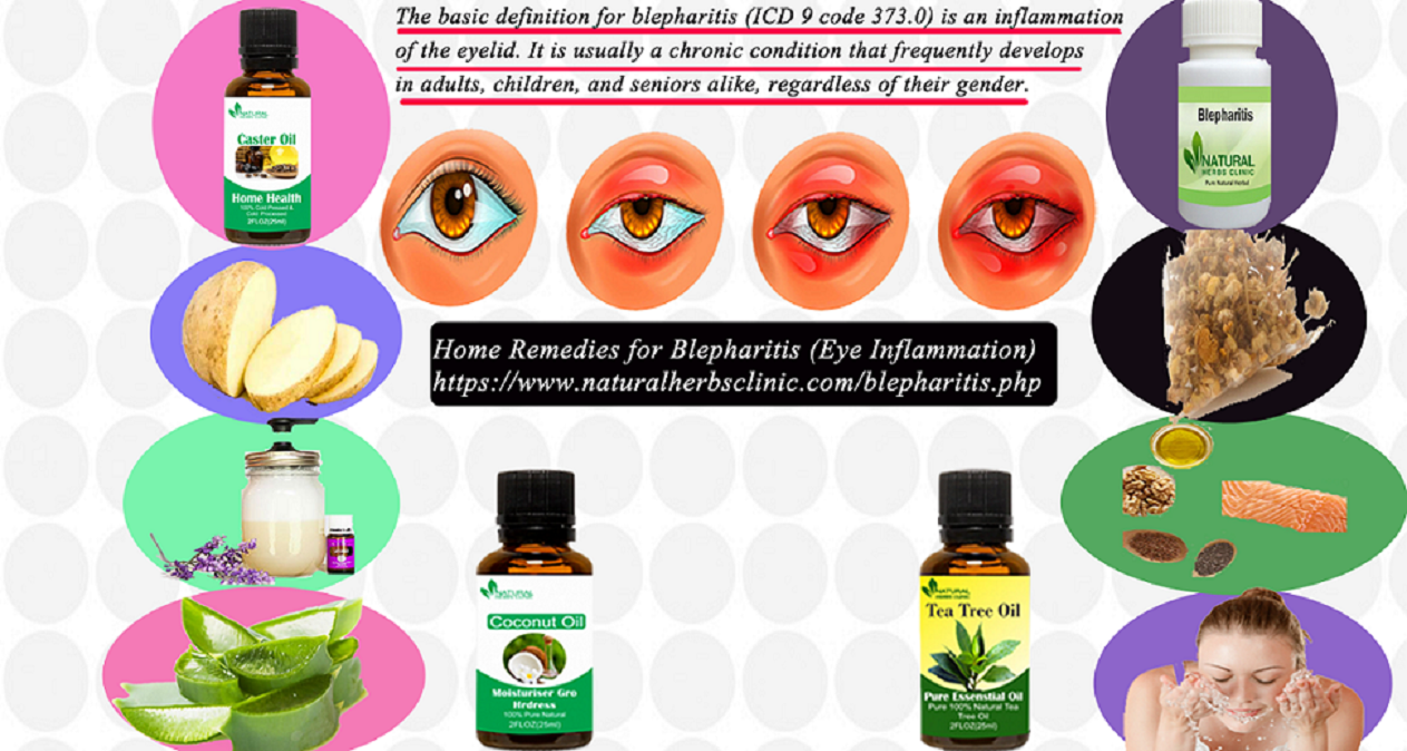 9 Home Remedies for Blepharitis (Eye Inflammation)
